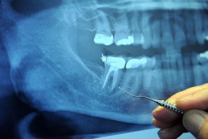 Top 5 Reasons for Gen Xers to Have Dental Insurance