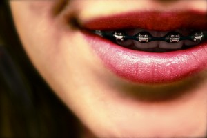 When Is the Right Time to Get Braces?